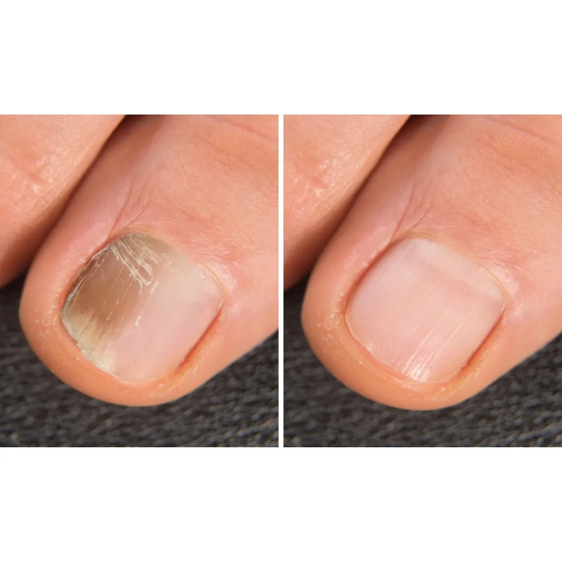 Nagel- & Fußpflegeprodukte·Nagellack|Die moderne Hausfrau Anti-Fuss- und Nagelpilzspray, 100 ml