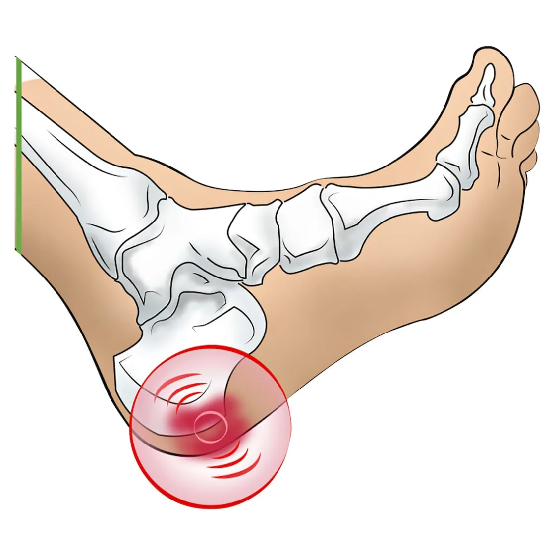 Fußpflegeprodukte·Fußschutz|Die moderne Hausfrau Fersenspornkissen, 1 Paar Herren