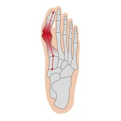 Bandagen·Hallux-Valgus Bandagen|Fußpflegeprodukte·Hallux Valgus|Die moderne Hausfrau Hallux Soft Bandage rechts
