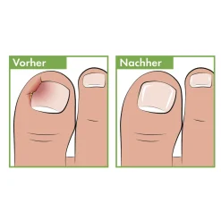 Nagel- & Fußpflegeprodukte·Nagelfeilen|Die moderne Hausfrau Pediküre Eckenfeile